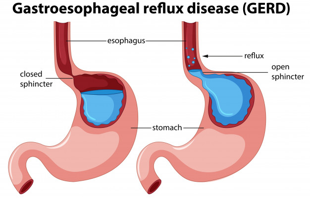 How to Fight Acid Reflux?